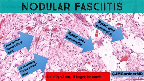 noduläre fasziitis|Nodular fasciitis